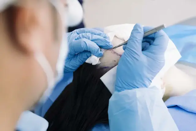 Hair transplant procedure at The Hair Dr clinic